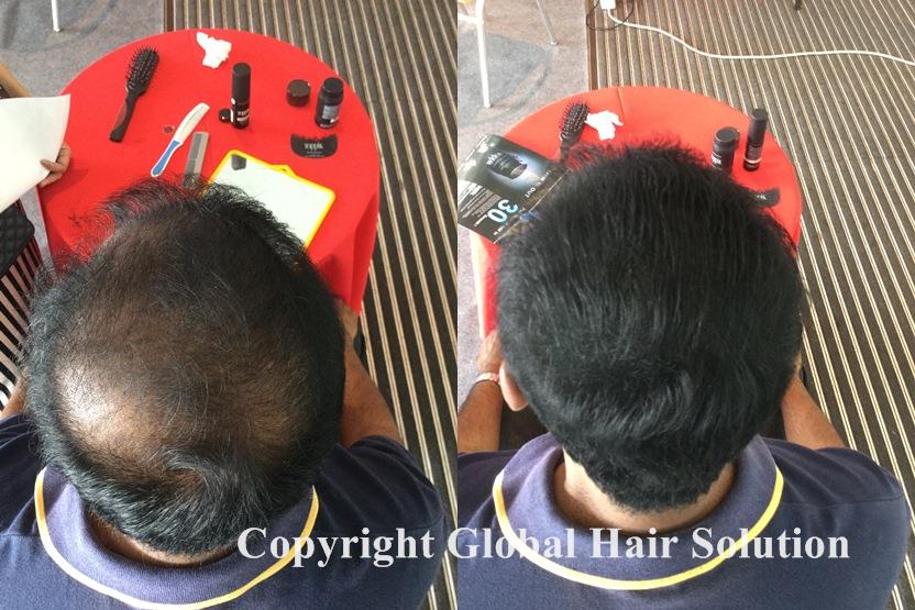 hair replacement with toppik